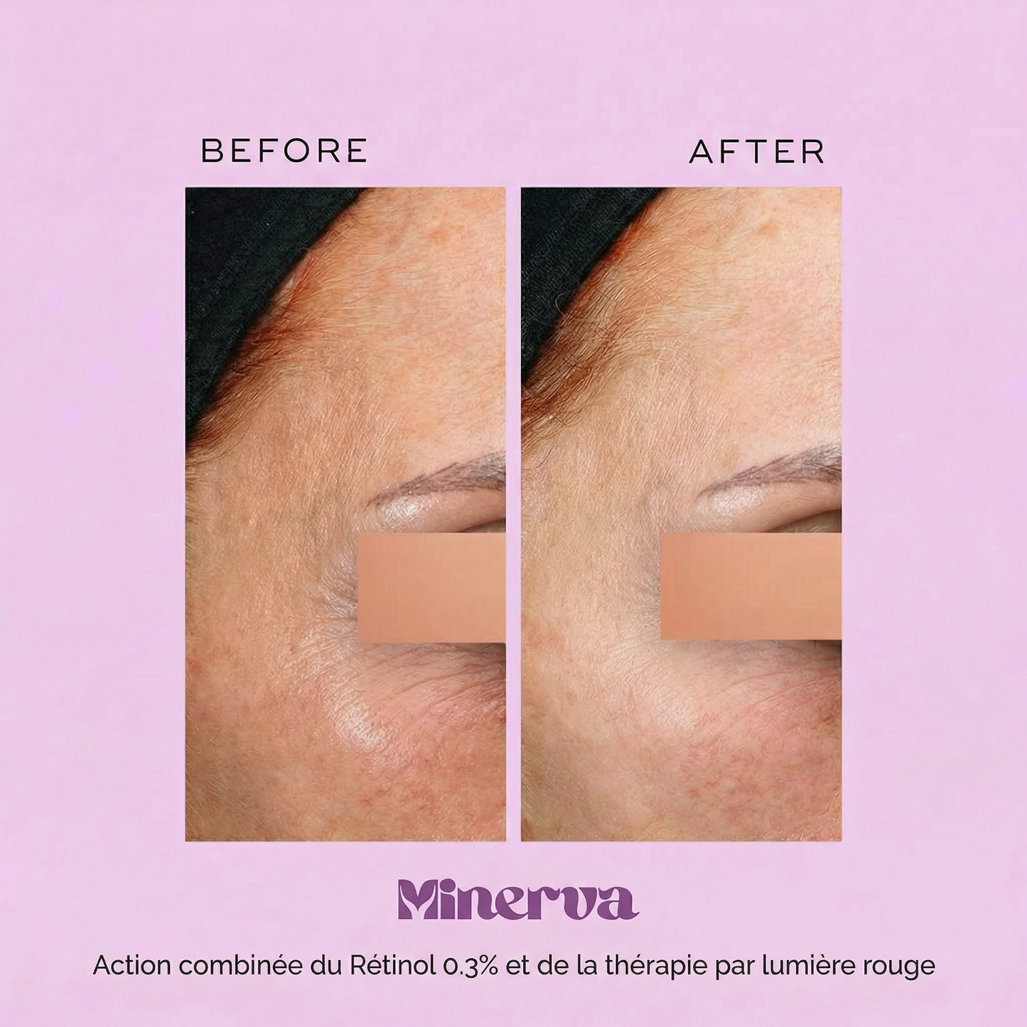 MINERVA Protocole Lifting & Fermeté (EMS + lumière rouge + rétinol 0.3%)