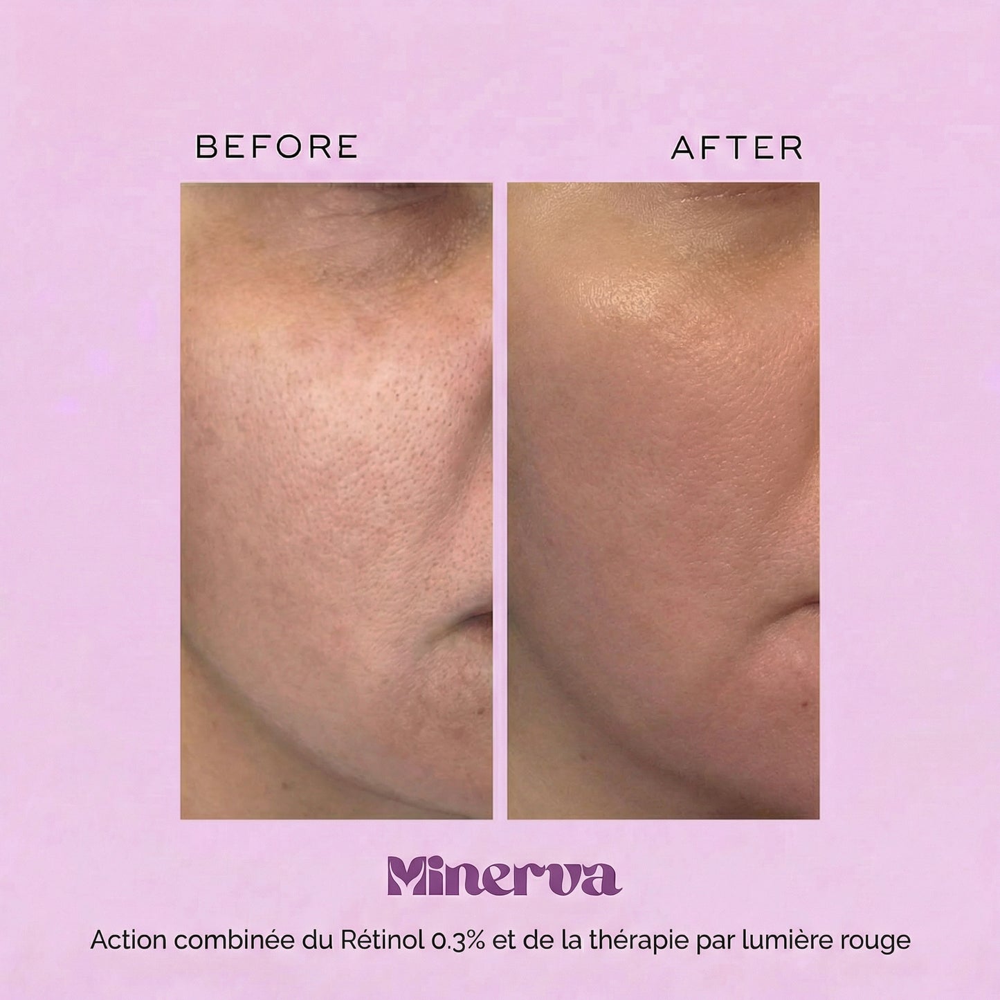MINERVA Protocole Lifting & Fermeté (EMS + lumière rouge + rétinol 0.3%)