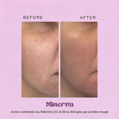 MINERVA Protocole Lifting & Fermeté (EMS + lumière rouge + rétinol 0.3%)